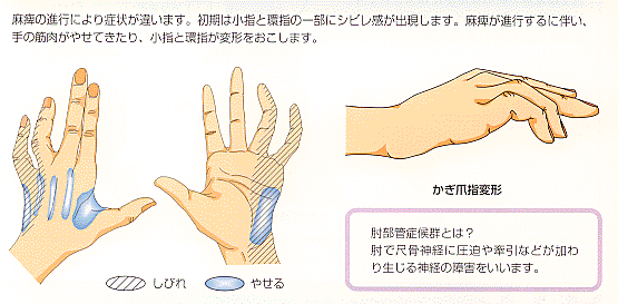 部 管 症候群 肘 小指と薬指のしびれの原因『肘部管症候群（尺骨神経麻痺）』の概要と筋トレ・ストレッチ・マッサージを含むリハビリ治療について解説します。